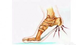  足跟痛症的防治 足跟痛应该如何防治
